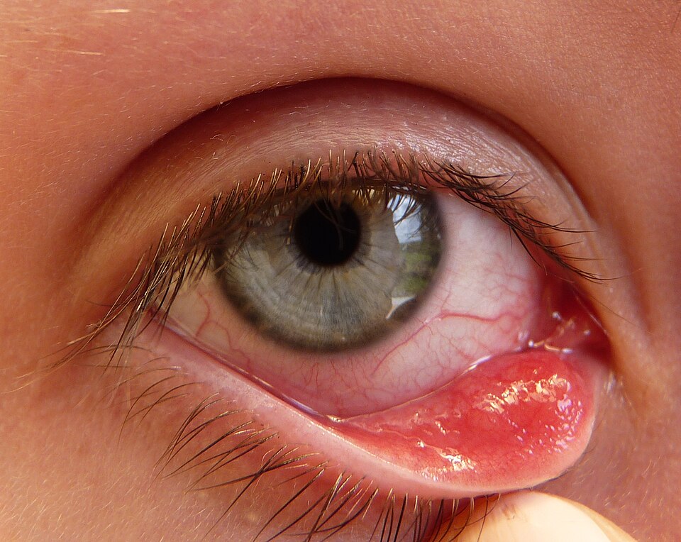 le chalazion est un probleme oculaire courant