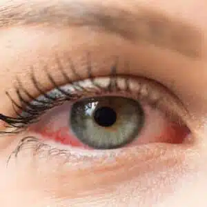 sécheresse oculaire, toutes les informations et traitements