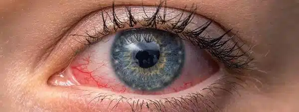 Sécheresse oculaire: Tout Savoir Sur Les Symptômes Et Solutions