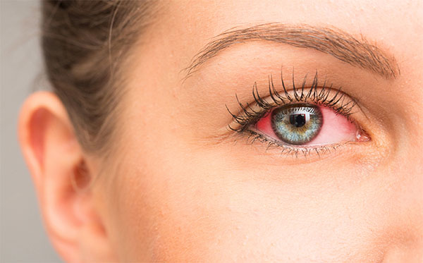 allergies oculaires symptomes, causes, soulager