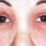 Allergies oculaires