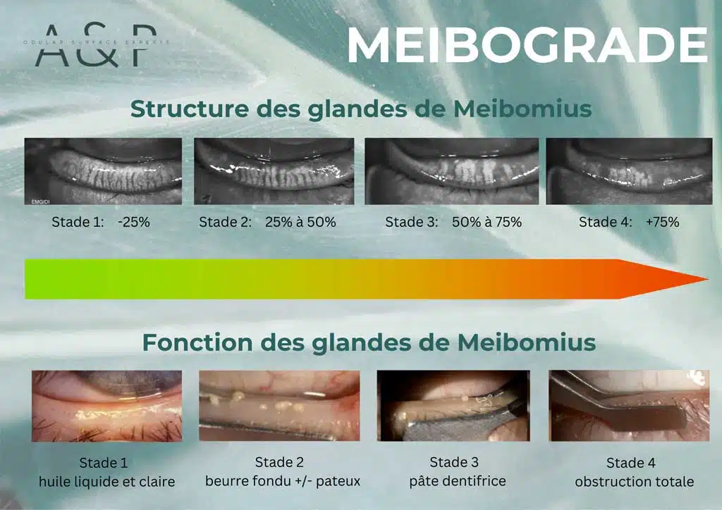 MEIBOGRADE – Outils diagnostic nécessaire en sécheresse oculaire