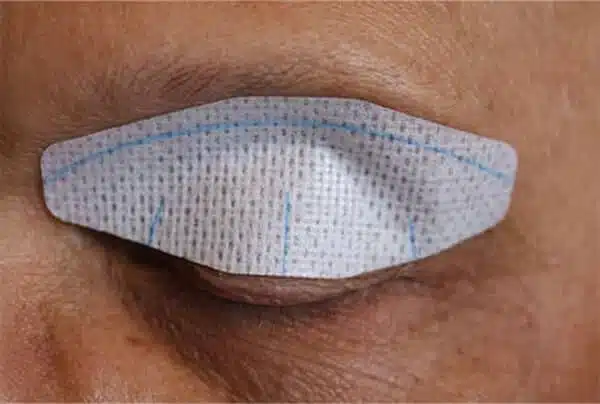 Patch Tarsal NICTAVI appliqué sur une paupière fermée, montrant sa conception ergonomique et son adhérence douce pour maintenir l'œil fermé sans irritation.
