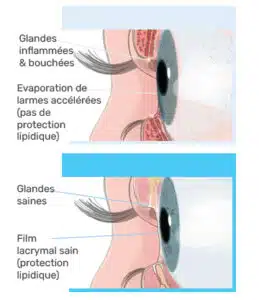 Dysfonctionnement des glandes de Meibomius (DGM) : une cause majeure de sécheresse oculaire